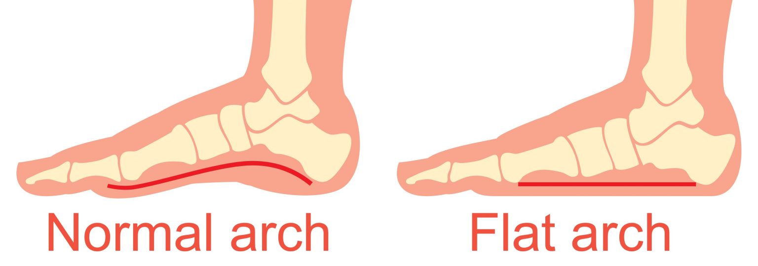 How Flat Feet Can Cause Foot Pain While Running Nagy Footcare