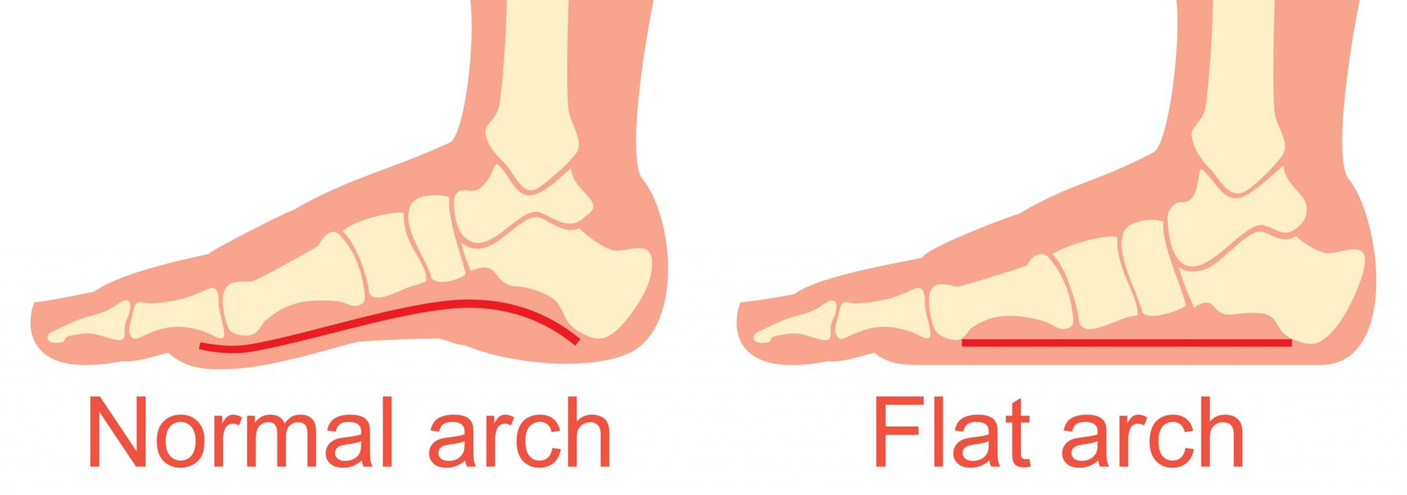 How Flat Feet Can Cause Foot Pain While Running Nagy Footcare
