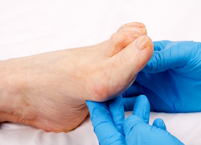 Ingrown toenails - Diagnosis & treatment - Mayo Clinic