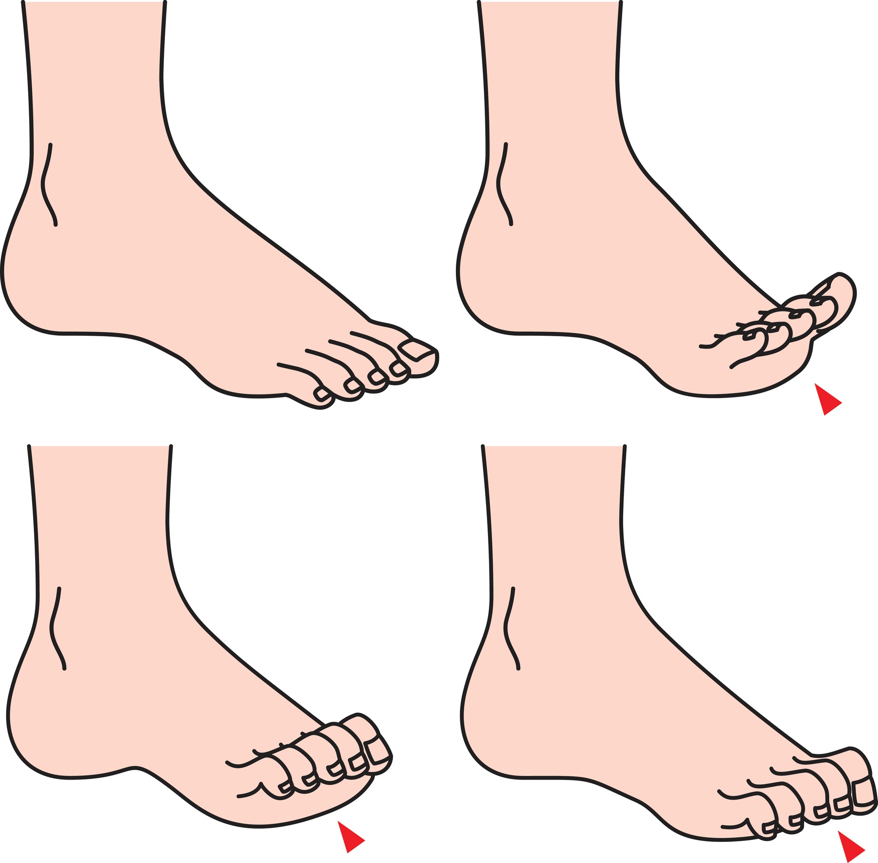 https://www.nagyfootcare.com/wp-content/uploads/What-to-Expect-After-Hammertoe-Surgery-531375065.jpg