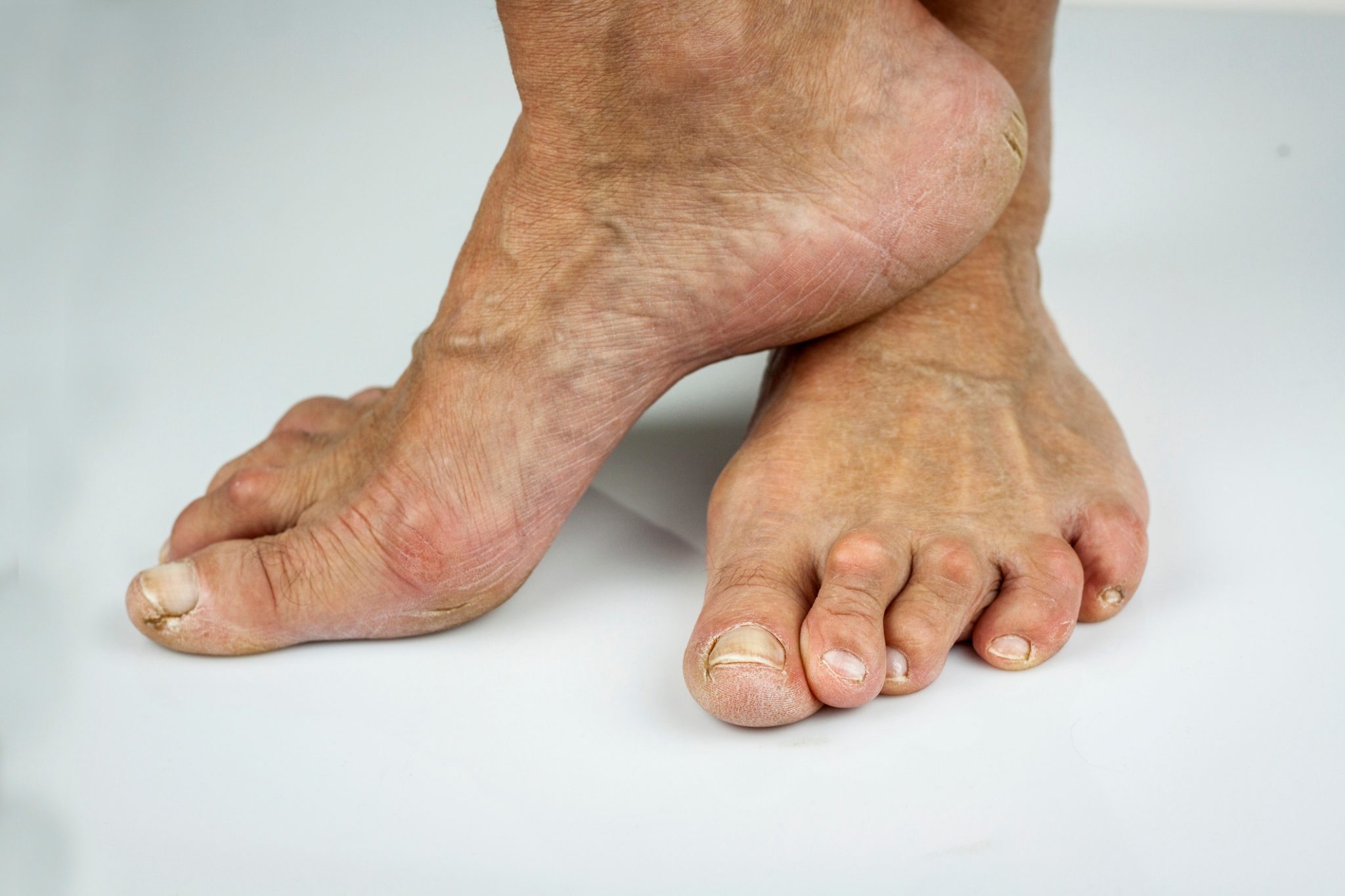 Foot Problems You May Experience as You Age Nagy Footcare