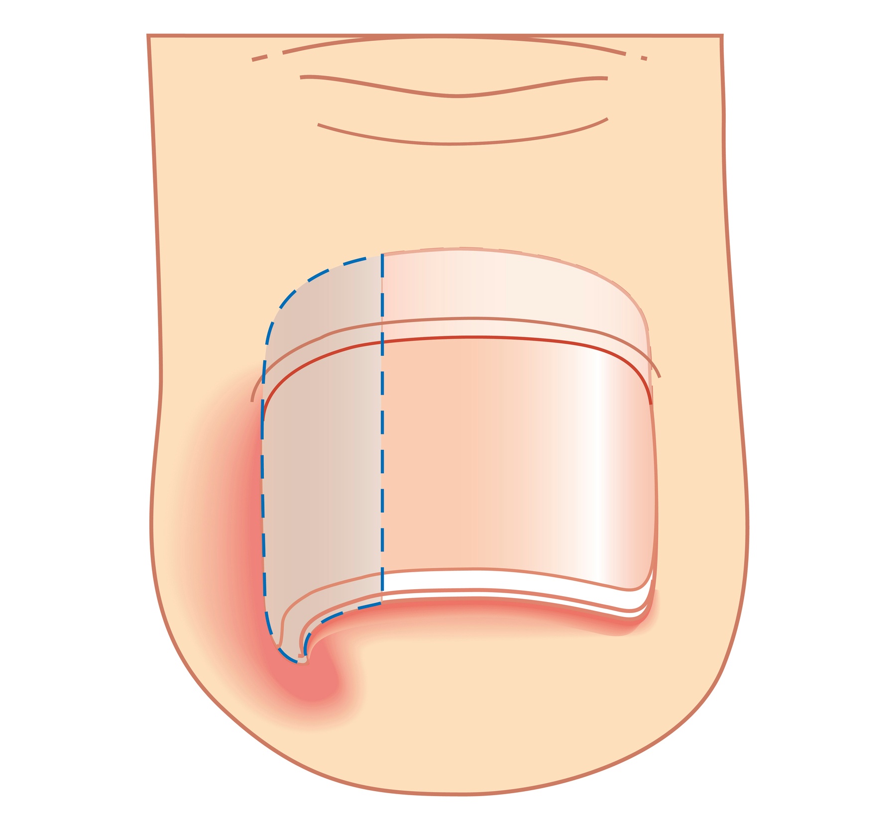 Ingrown Nail Diagram