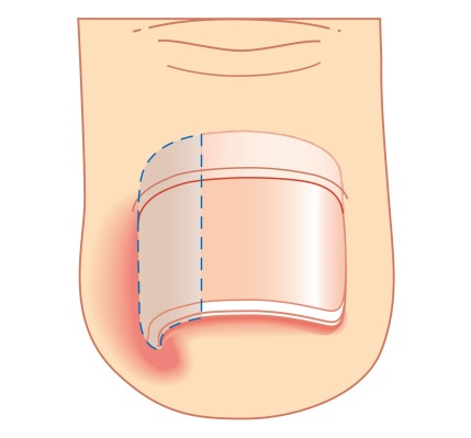 Why Does My Ingrown Toenail Keep Coming Back? | Nagy Footcare Why Does My Ingrown Toenail Keep Coming Back? | Nagy Footcare