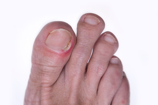 Diabetes and Your Feet | CDC